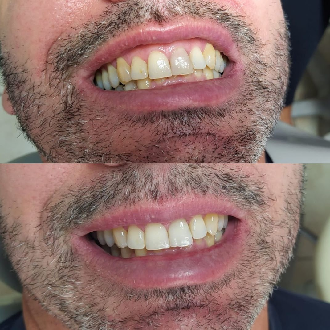 Antes e depois — Clareamento Dental Masculino em Curitiba